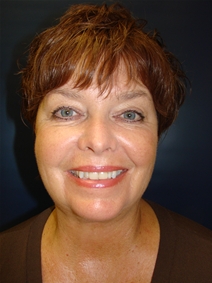 Liposuction After Photo by J Michael Conkright, MD; ,  - Case 20664