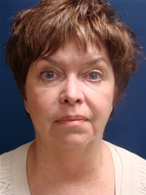 Liposuction Before Photo by J Michael Conkright, MD; ,  - Case 20664