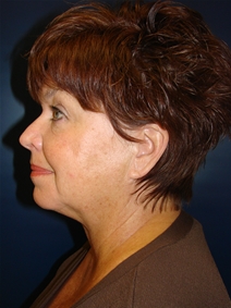 Liposuction After Photo by J Michael Conkright, MD; ,  - Case 20664