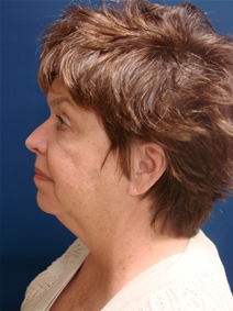 Liposuction Before Photo by J Michael Conkright, MD; ,  - Case 20664