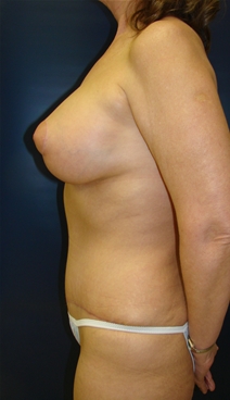 Tummy Tuck After Photo by J Michael Conkright, MD; ,  - Case 20709
