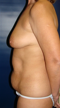 Tummy Tuck Before Photo by J Michael Conkright, MD; ,  - Case 20709