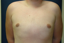 Male Breast Reduction After Photo by J Michael Conkright, MD; ,  - Case 20710