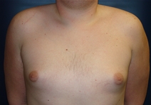 Male Breast Reduction Before Photo by J Michael Conkright, MD; ,  - Case 20710