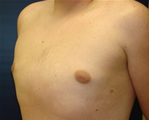 Male Breast Reduction After Photo by J Michael Conkright, MD; ,  - Case 20710