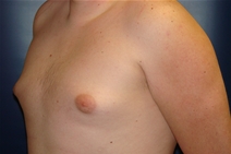 Male Breast Reduction Before Photo by J Michael Conkright, MD; ,  - Case 20710