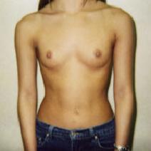 Breast Augmentation Before Photo by John Cozzone, MD; Paramus, NJ - Case 7053