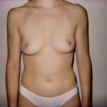 Breast Augmentation Before Photo by John Cozzone, MD; Paramus, NJ - Case 7056
