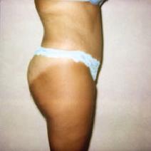 Tummy Tuck After Photo by John Cozzone, MD; Paramus, NJ - Case 7057