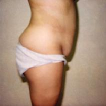 Tummy Tuck Before Photo by John Cozzone, MD; Paramus, NJ - Case 7057
