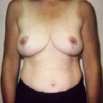 Breast Reduction After Photo by John Cozzone, MD; Paramus, NJ - Case 7059