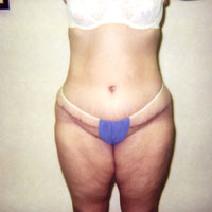 Body Contouring After Photo by John Cozzone, MD; Paramus, NJ - Case 7060