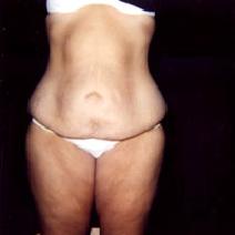 Body Contouring Before Photo by John Cozzone, MD; Paramus, NJ - Case 7060
