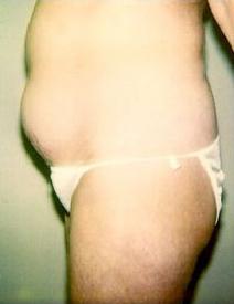 Liposuction Before Photo by John Cozzone, MD; Paramus, NJ - Case 7062