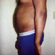 Liposuction After Photo by John Cozzone, MD; Paramus, NJ - Case 7063