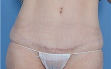 Tummy Tuck After Photo by Gregory Ruff, MD; Chapel Hill, NC - Case 35183