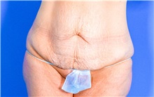 Tummy Tuck Before Photo by Gregory Ruff, MD; Chapel Hill, NC - Case 35183