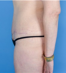 Tummy Tuck After Photo by Gregory Ruff, MD; Chapel Hill, NC - Case 35184