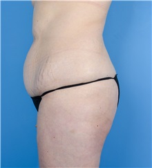 Tummy Tuck Before Photo by Gregory Ruff, MD; Chapel Hill, NC - Case 35184