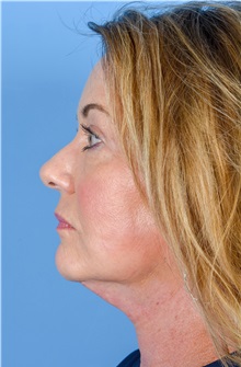 Facelift After Photo by Gregory Ruff, MD; Chapel Hill, NC - Case 35186