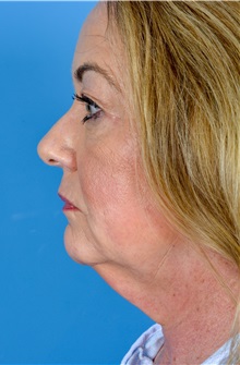 Facelift Before Photo by Gregory Ruff, MD; Chapel Hill, NC - Case 35186