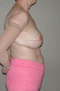 Breast Reconstruction After Photo by Dann Leonard, MD; Salem, OR - Case 10226