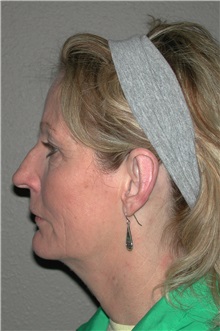 Ear Surgery After Photo by Dann Leonard, MD; Salem, OR - Case 10229
