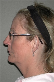 Ear Surgery Before Photo by Dann Leonard, MD; Salem, OR - Case 10229