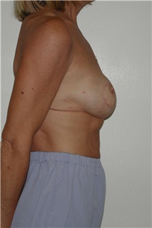 Breast Reconstruction After Photo by Dann Leonard, MD; Salem, OR - Case 10230