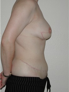 Breast Reconstruction After Photo by Dann Leonard, MD; Salem, OR - Case 10231