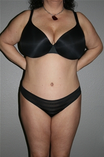 Tummy Tuck After Photo by Dann Leonard, MD; Salem, OR - Case 21657