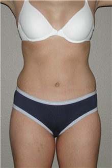 Tummy Tuck After Photo by Dann Leonard, MD; Salem, OR - Case 6672