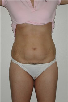 Tummy Tuck Before Photo by Dann Leonard, MD; Salem, OR - Case 6672