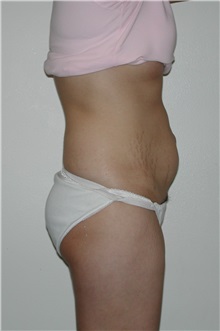 Tummy Tuck Before Photo by Dann Leonard, MD; Salem, OR - Case 6672