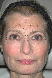 Botulinum Toxin Before Photo by Dann Leonard, MD; Salem, OR - Case 6673