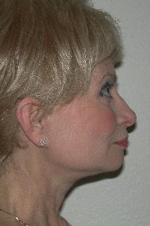 Facelift After Photo by Dann Leonard, MD; Salem, OR - Case 6674