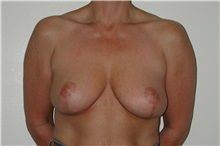 Breast Reduction After Photo by Dann Leonard, MD; Salem, OR - Case 6676