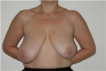 Breast Reduction Before Photo by Dann Leonard, MD; Salem, OR - Case 6676