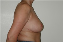 Breast Reduction After Photo by Dann Leonard, MD; Salem, OR - Case 6676