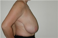 Breast Reduction Before Photo by Dann Leonard, MD; Salem, OR - Case 6676