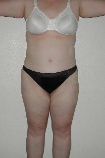 Tummy Tuck After Photo by Dann Leonard, MD; Salem, OR - Case 6677