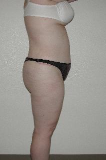 Tummy Tuck After Photo by Dann Leonard, MD; Salem, OR - Case 6677