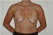 Breast Augmentation Before Photo by Dann Leonard, MD; Salem, OR - Case 6678