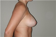 Breast Augmentation After Photo by Dann Leonard, MD; Salem, OR - Case 6678