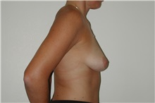Breast Augmentation Before Photo by Dann Leonard, MD; Salem, OR - Case 6678