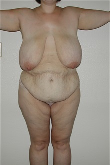 Body Contouring Before Photo by Dann Leonard, MD; Salem, OR - Case 6783