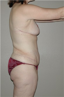 Body Contouring After Photo by Dann Leonard, MD; Salem, OR - Case 6783