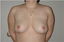 Breast Reduction After Photo by Dann Leonard, MD; Salem, OR - Case 6785