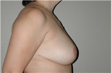 Breast Reduction After Photo by Dann Leonard, MD; Salem, OR - Case 6785