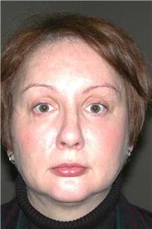 Eyelid Surgery After Photo by Dann Leonard, MD; Salem, OR - Case 8715